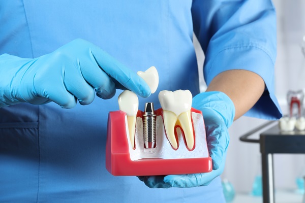 Dental Implant Restoration Johns Creek, GA