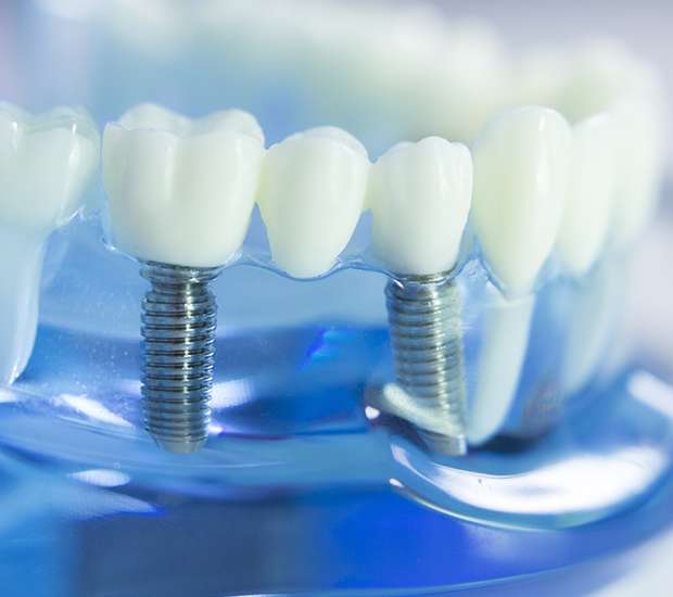 Johns Creek Dental Implants