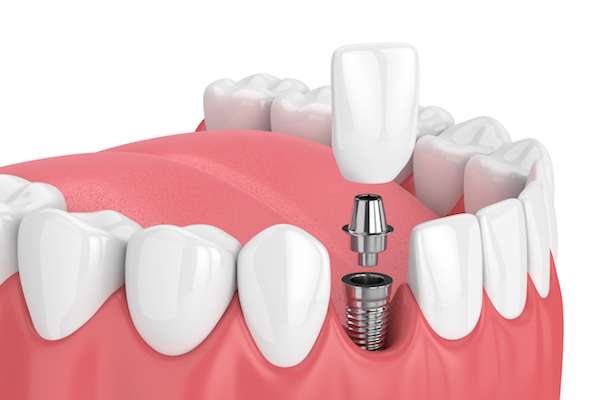 How Painful is Dental Implant Surgery from Parsons Pointe Dental Care in Johns Creek, GA