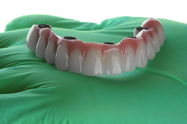 When Are Implant Supported Dentures Recommended?