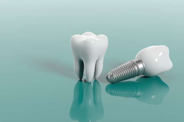 Questions to Ask Your Implant Dentist from Parsons Pointe Dental Care in Johns Creek, GA