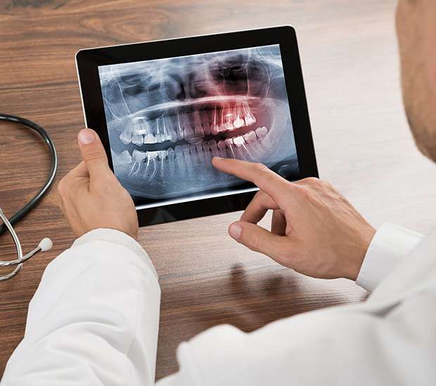 Johns Creek Types of Dental Root Fractures